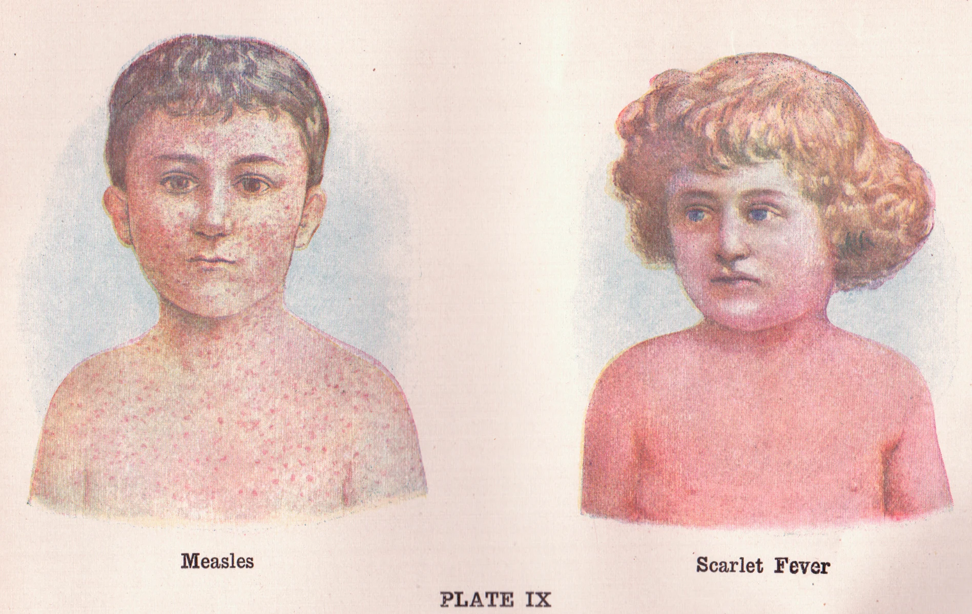 A historical image showing the difference between measles and scarlet fever, another disease you probably forgot people got. Sue Clark/Flickr